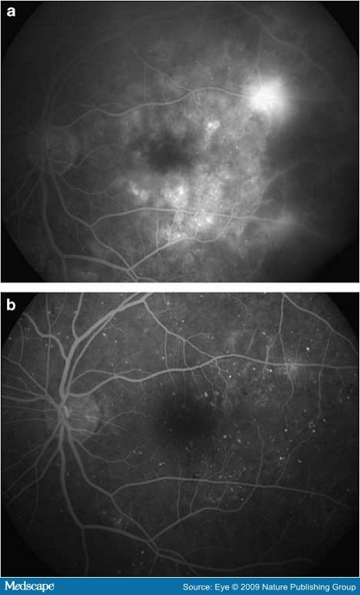 intravitreal avastin. intravitreal bevacizumab