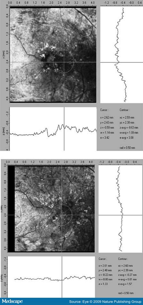 intravitreal avastin. intravitreal bevacizumab