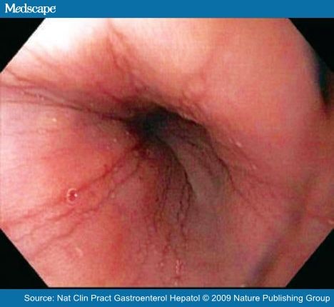 Eosinophilic Esophagitis