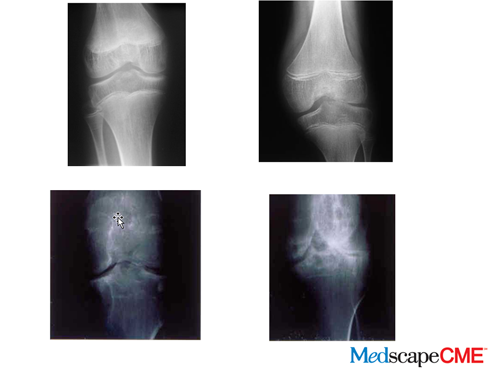 Hip joint effusion in adults