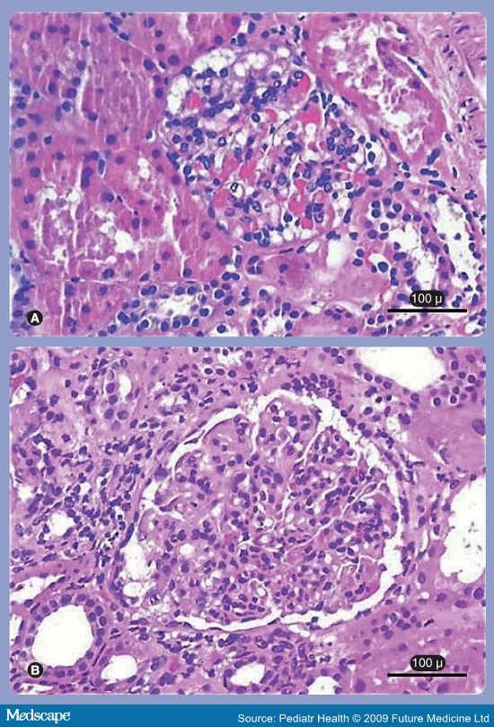  non-obese control with secondary focal segmental glomerulosclerosis.