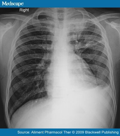 tuberculosis x ray. X-ray chest PA view showing