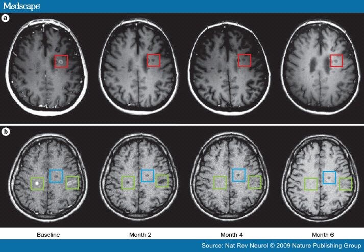 multiple sclerosis mri images. with multiple sclerosis.
