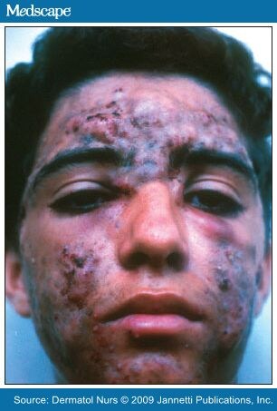 worst acne pictures