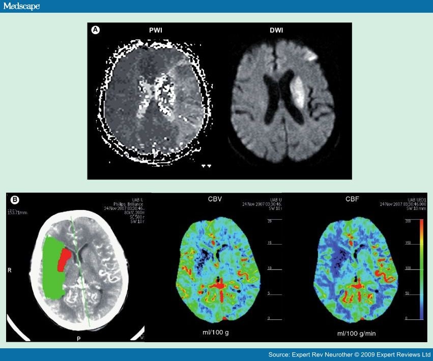 Cerebral Perfusion Imaging