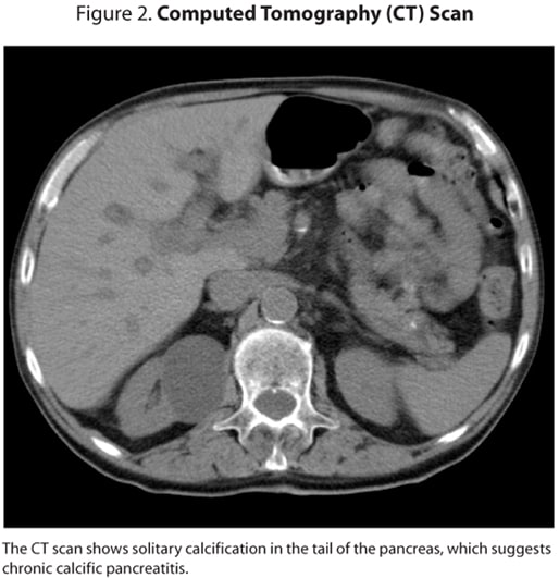 Pancreatitis Ct Scan. pancreatitis, a CT scan