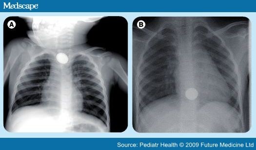 Aspiration Of Foreign Body. (B) Foreign body at the lower