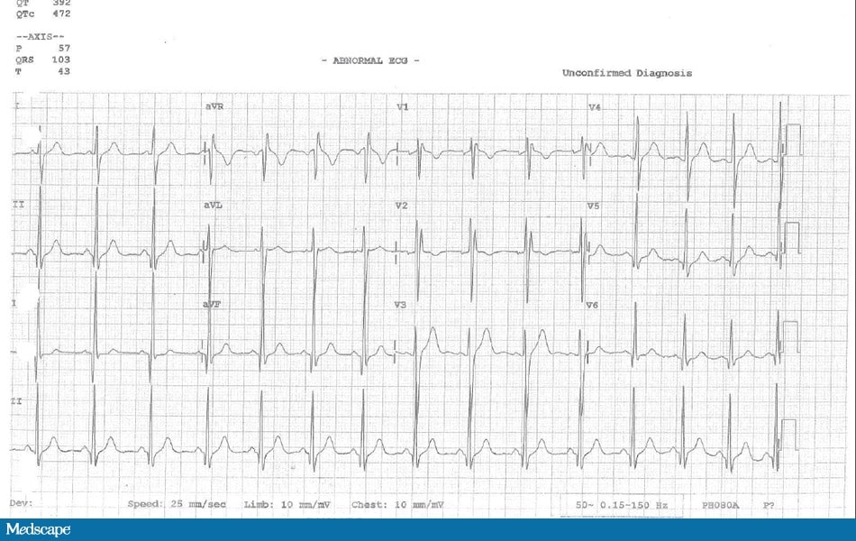 Tca Ecg