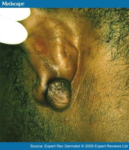 Keloid of the earlobe secondary to piercing. Keloid of the earlobe secondary to piercing.