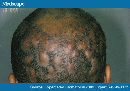 dissecting cellulitis of the scalp #10