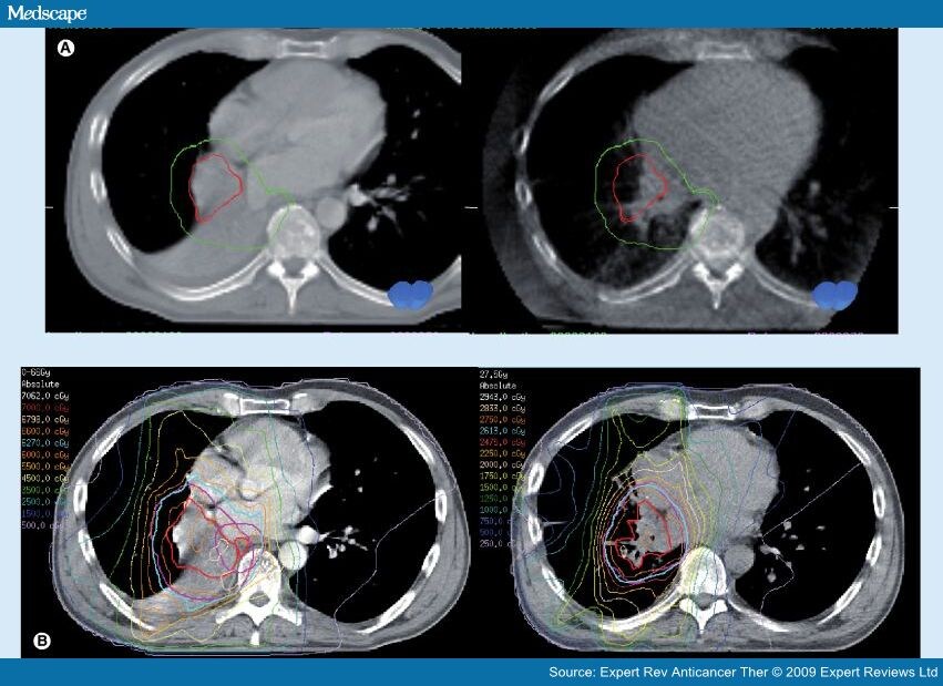 Gross Tumor Volume