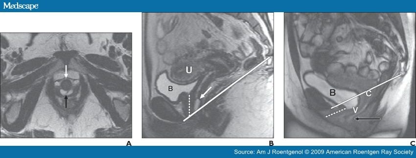 Suburethral Cyst