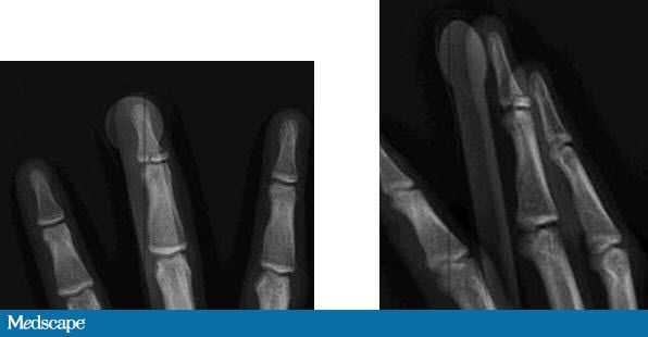 distal joint