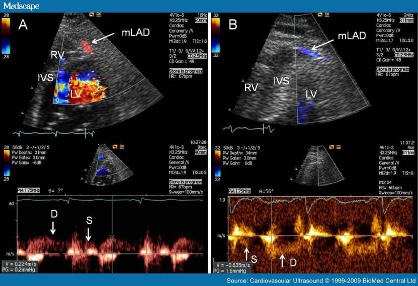 Transthoracic Echocardiography For Imaging The Coronary Artery Segments