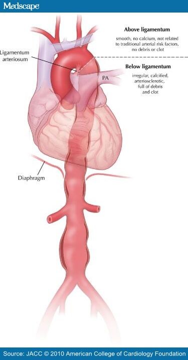 descending thoracic aortic pseudoaneurysm icd 10