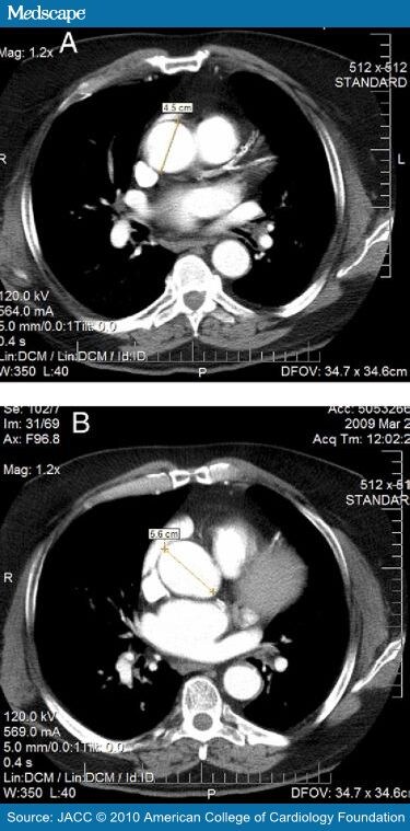 hx thoracic aortic aneurysm icd 10