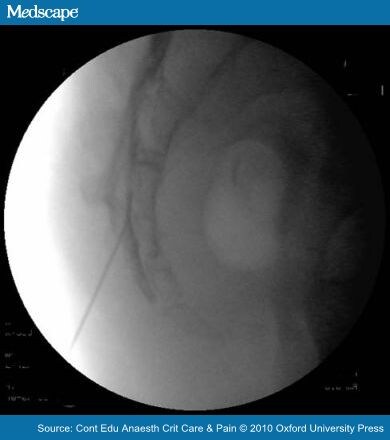 Thoracic transforaminal epidural steroid injection technique