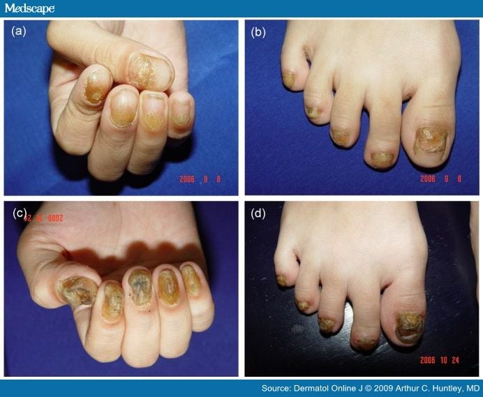 Severe nail dystrophy of all 20 nails at presentation characterized by 