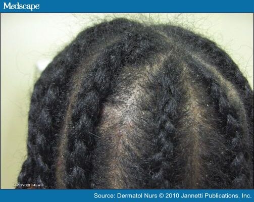 Alopecia vertex photo