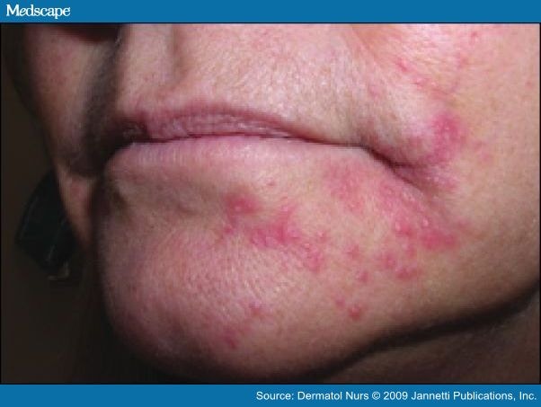 Red Rash Corner of Mouth Spreading - Dermatology - MedHelp