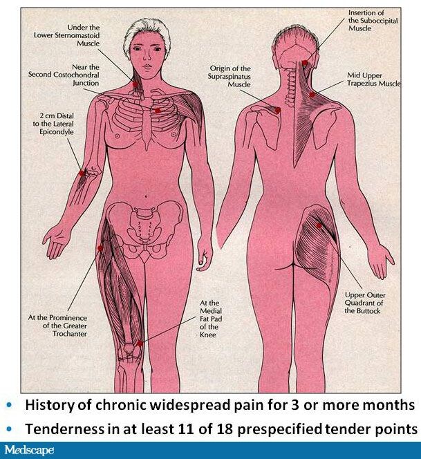 Fibromyalgia Trigger Points Chart