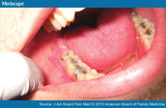 operculum dental