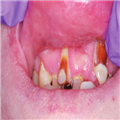 severe calculus buildup in mouth