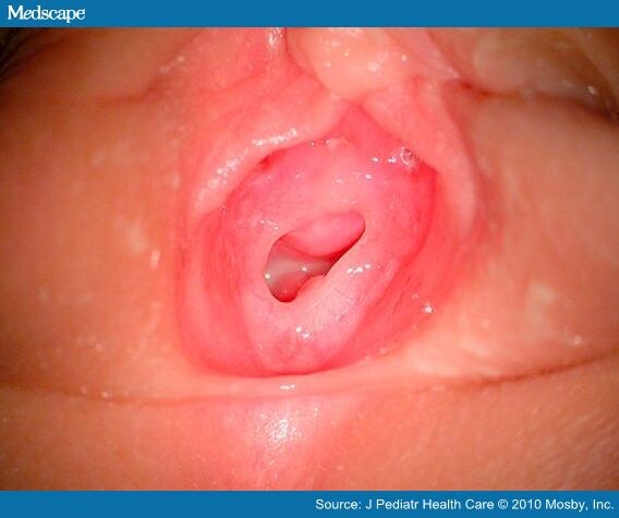 Hyponatremia Medscape Hot Sex Picture