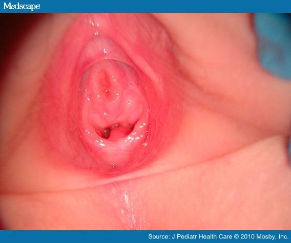 Hymen Image Photo Vagina 48