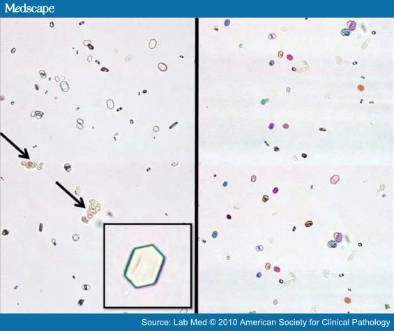 amorphous urate crystals in urine. +urate+crystals+in+urine