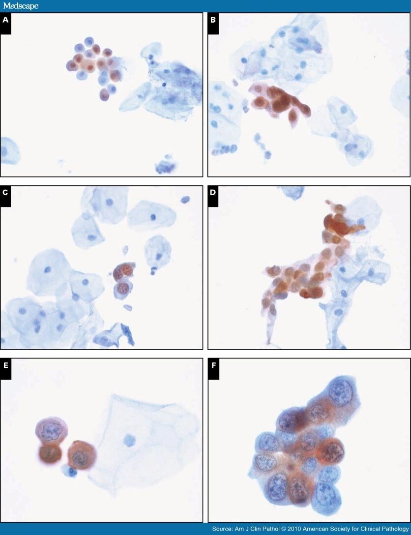 low-grade-squamous-intraepithelial-lesion-mild-dysplasia-danyalsak