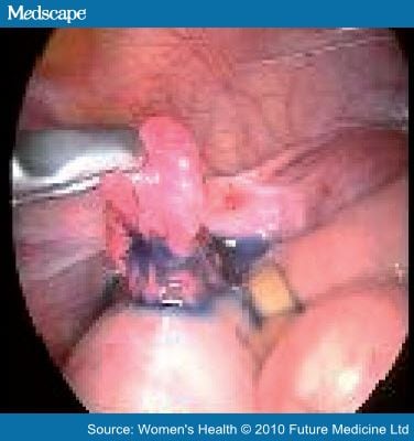 Fallopian Tube Histology. of Dye Post-Fallopian Tube