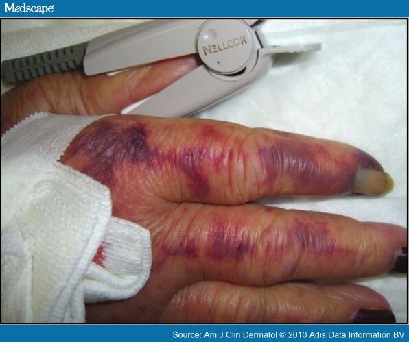 Paroxysmal Finger Haematoma