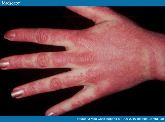 Acute Lyme Infection Presenting With Amyopathic Dermatomyositis