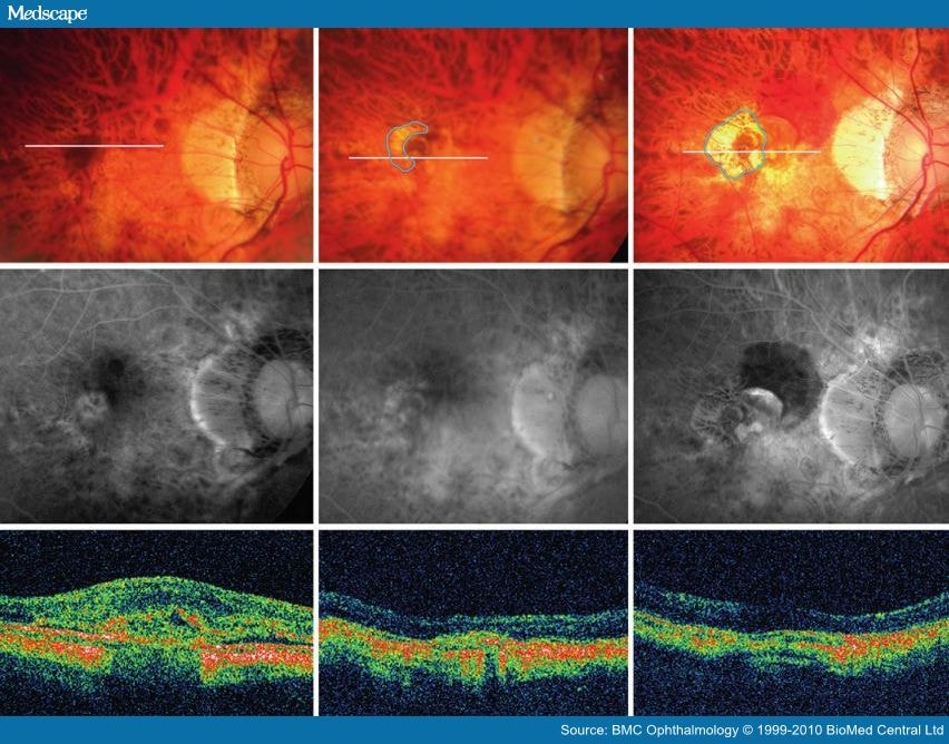 intravitreal avastin. intravitreal bevacizumab.