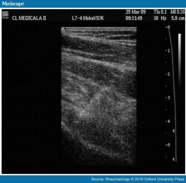 US of the hip in anterior longitudinal scanning. Visualization of the needle 
