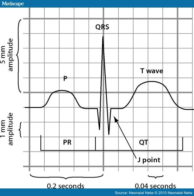 Retrograde P Wave