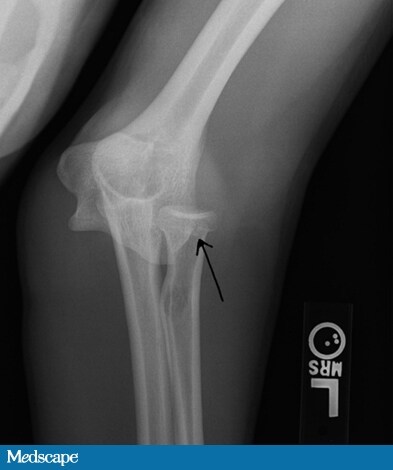 Broken+Ulna+Dislocated+Elbow ... meandmyinterest.blogspot.com/2011/07/broken-ulna-dislocated-elbow.html