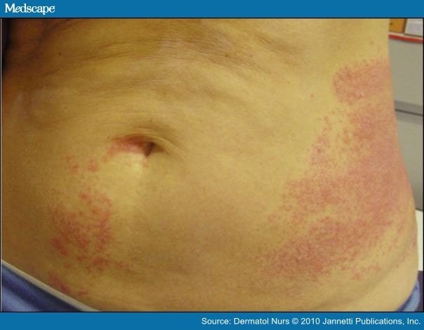 7-causes-of-red-spots-and-bumps-on-skin-with-pictures-allure