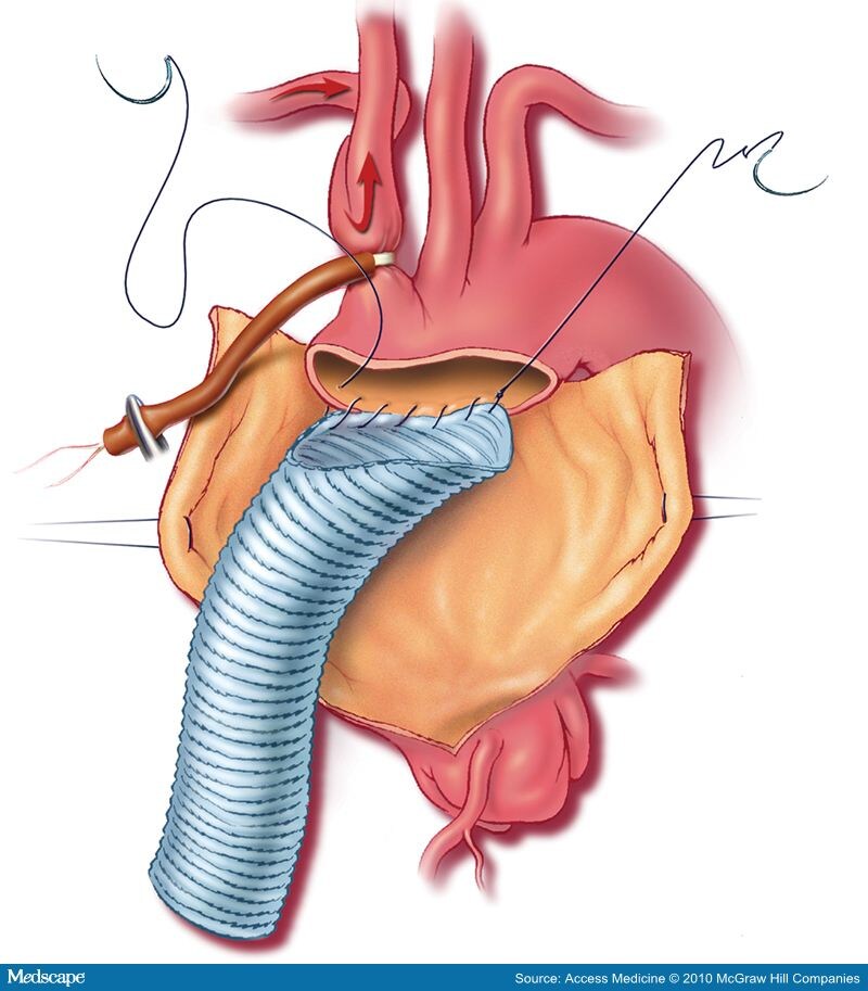 Aortic Artery