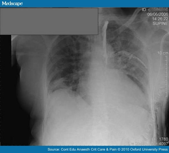 Chest tube size - picture from medscape