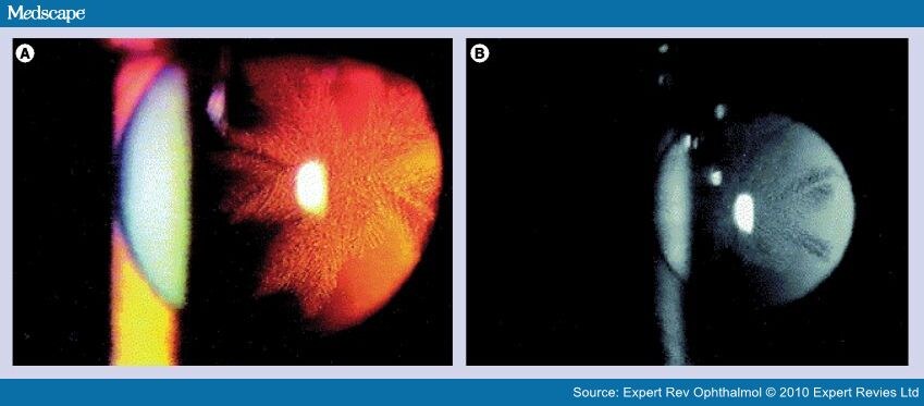 Cataract Grading Scale