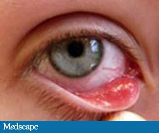 Children Eye Infection