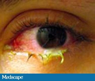 Children Eye Infection