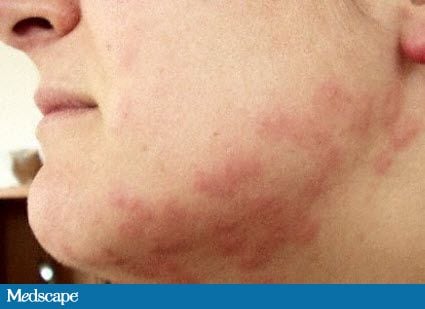 Figure 2 . Bed bug bites on a woman's face. Wikipedia, public domain ...