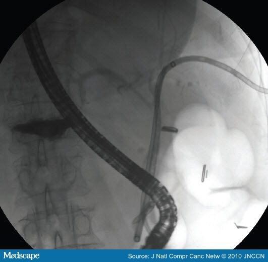 common bile duct cat. common bile duct obstruction.