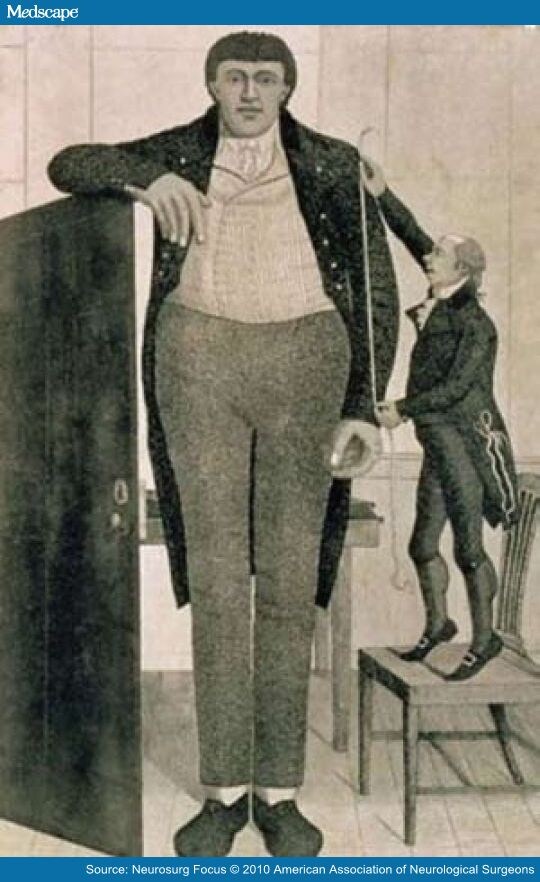 Research paper on gigantism