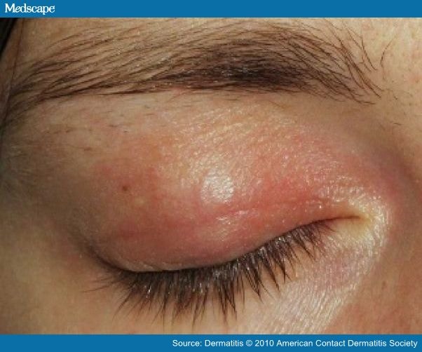 Eyelid Dermatitis Treatment and Symptoms - Seborrheic ...
