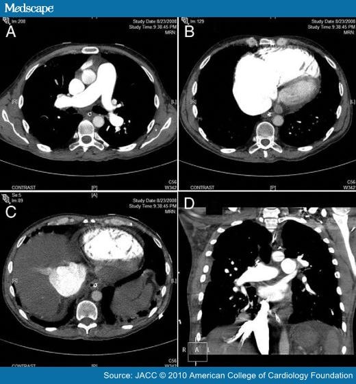  due to acute respiratory distress syndrome from aspiration pneumonia.