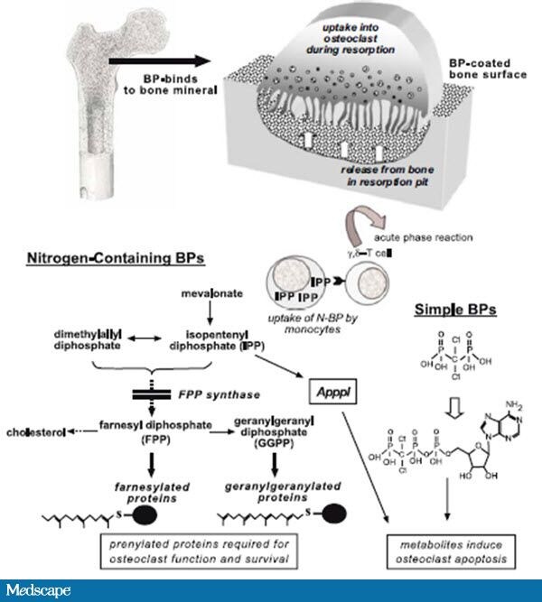 Pics For > Bisphosphonates Mechanism Of Action” src=”http://dm5migu4zj3pb.cloudfront.net/manuscripts/17000/17051/medium/JCI0217051.f1.jpg” alt=”Pics For > Bisphosphonates Mechanism Of Action”><img height= Bisphosphonates for the Treatment of Myeloma Bone Disease